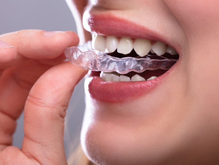 Straighten Your Teeth Discreetly in Manteca CA — Valley View Dental Manteca