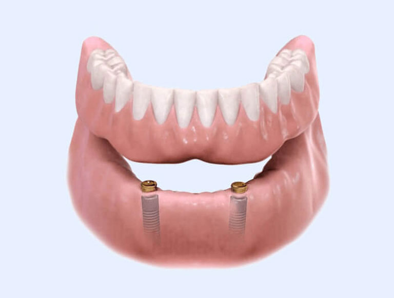 Fixed vs. Removable Solutions